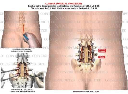 2 level - L4-5 & L5-S1 Lumbar spine fusion - discectomies