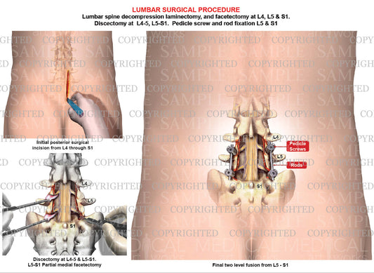 1 level Lumbar spine fusion
