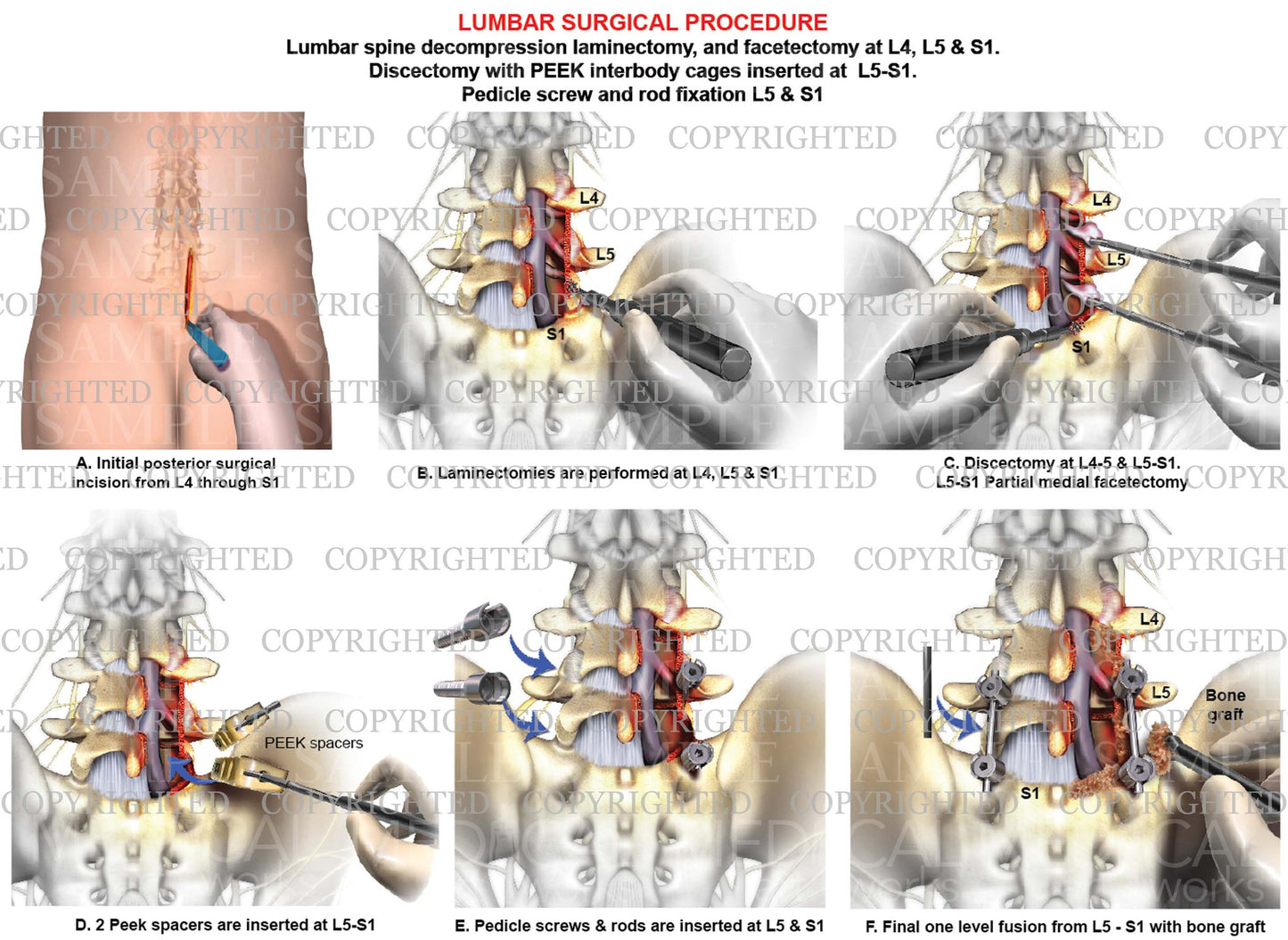Lumbar interbody fusion surgical procedure
