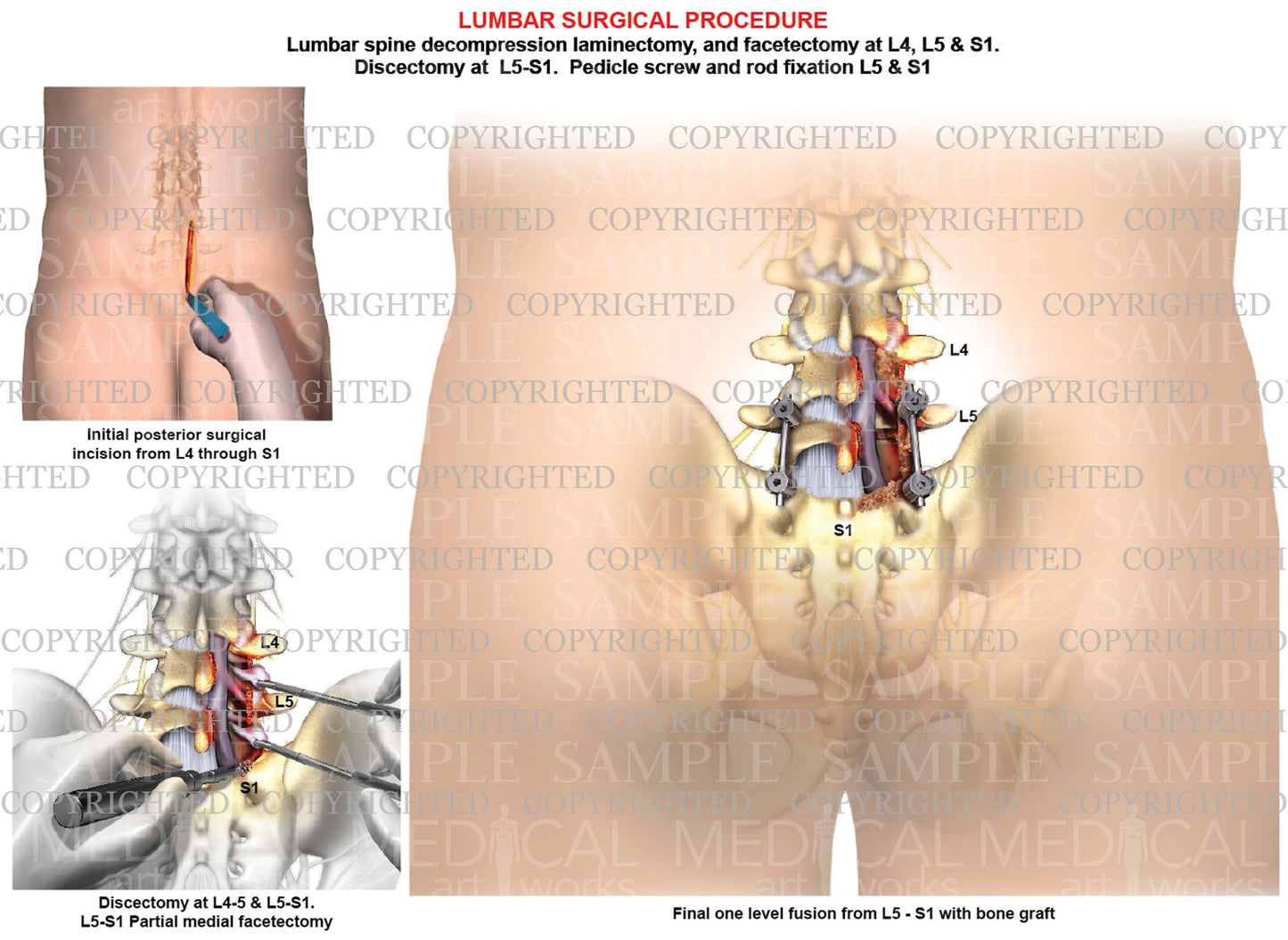1 Level - L4-5 and L5-S1 Lumbar right sided discectomies