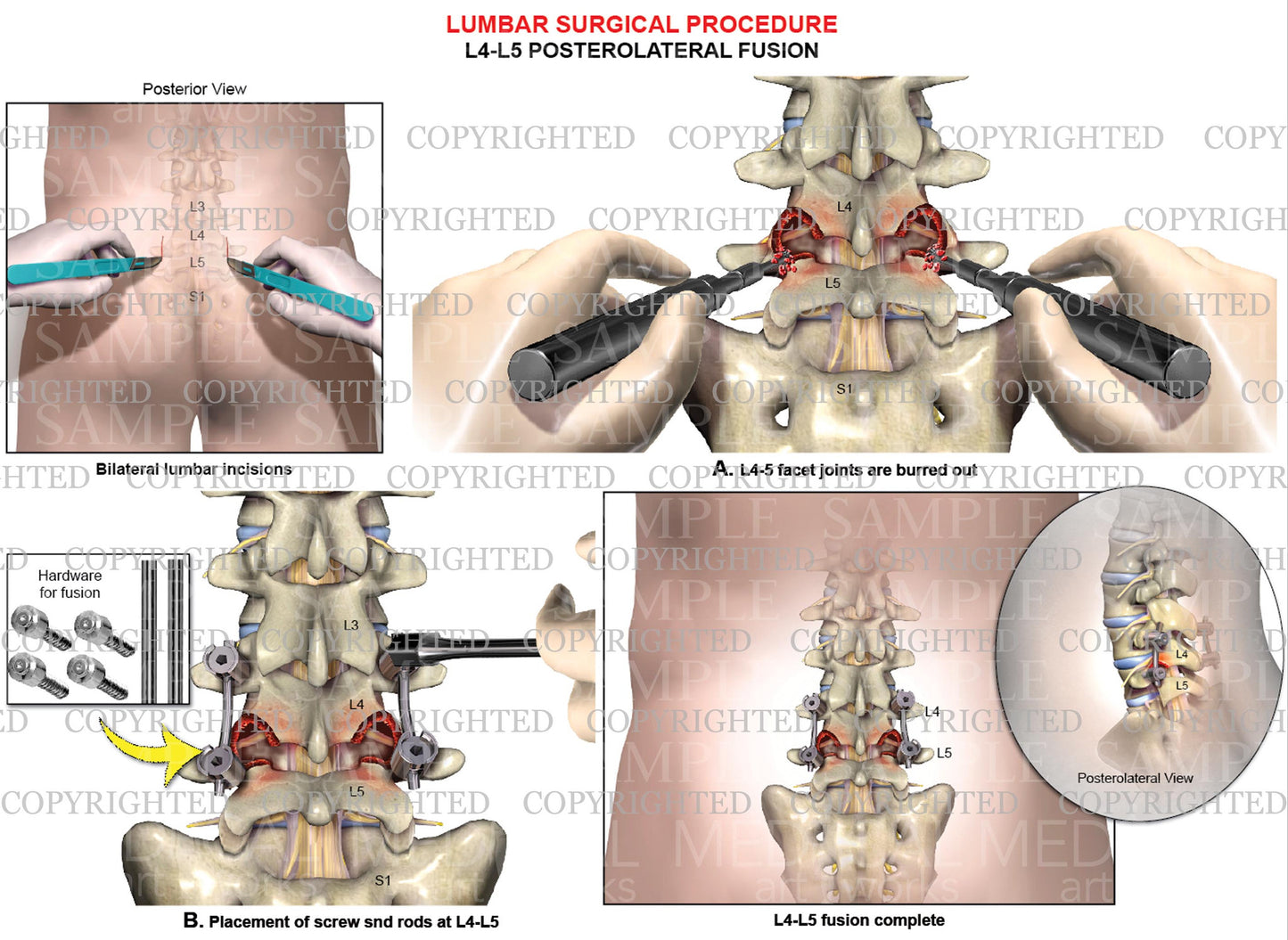 Posterior lateral lumbar interbody fusion