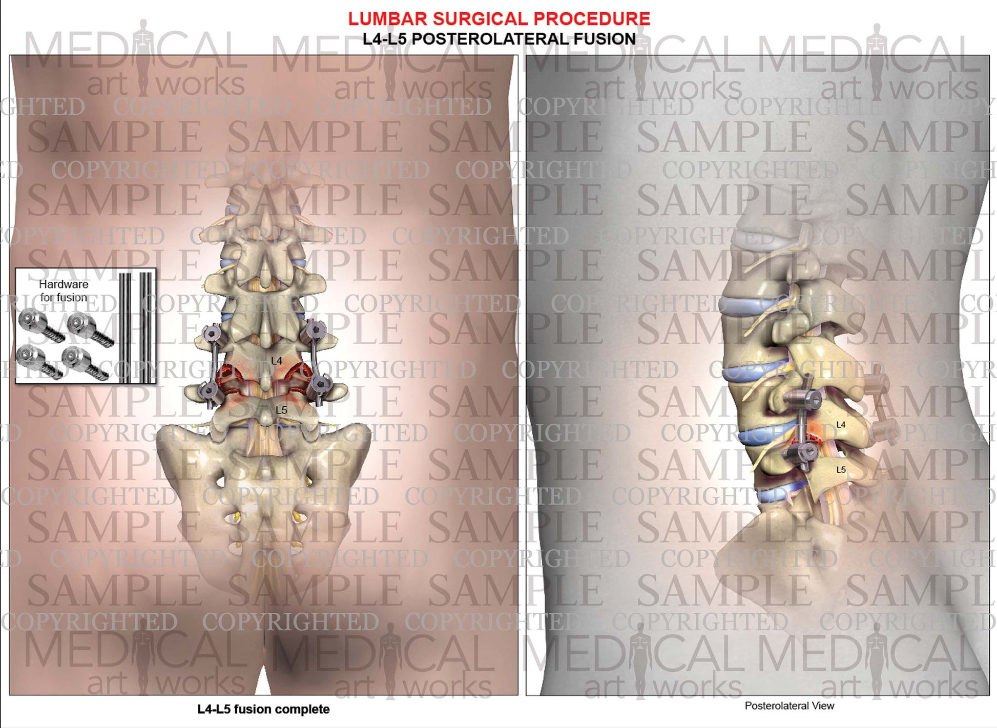 Lumbar spine posterior lateral inter-body fusion 