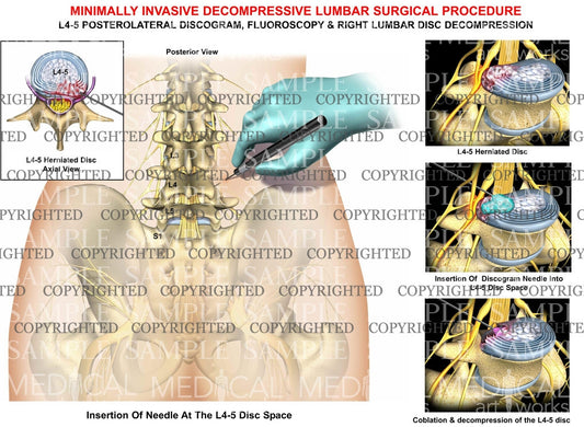 Minimally invasive decompressive lumbar Surgical Procedure