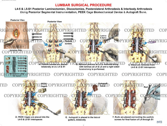 2 Level - L4-5 & L5-S1 Posterior lumbar interbody fusion surgery - Laminectomies - Discectomies