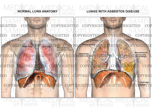 Lungs with asbestos disease compared with normal lungs