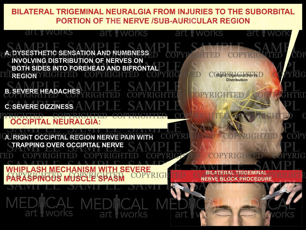 Right trigeminal nerve injury