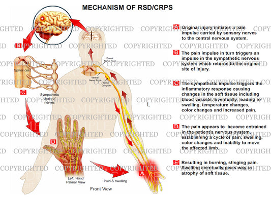 MECHANISM OF RSD: Reflex Sympathetic Dystrophy (Complex Regional Pain) Left hand