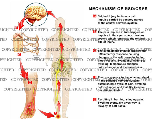 MECHANISM OF RSD: Reflex Sympathetic Dystrophy (Complex Regional Pain) 1