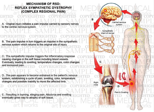 MECHANISM OF RSD (Right knee): Reflex Sympathetic Dystrophy (Complex Regional Pain)