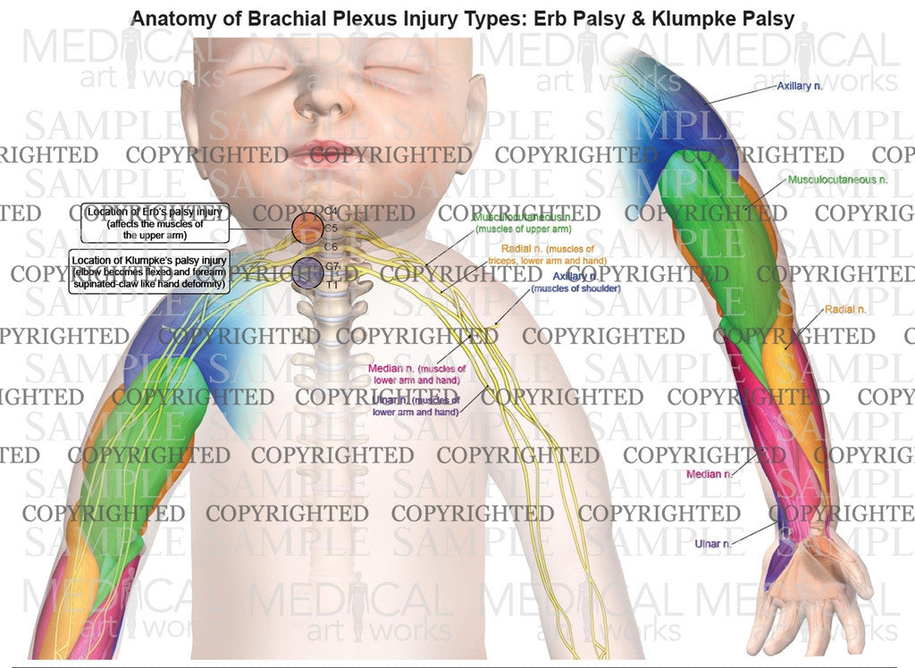 Normal anatomy of brachial plexus and location of palsy injury