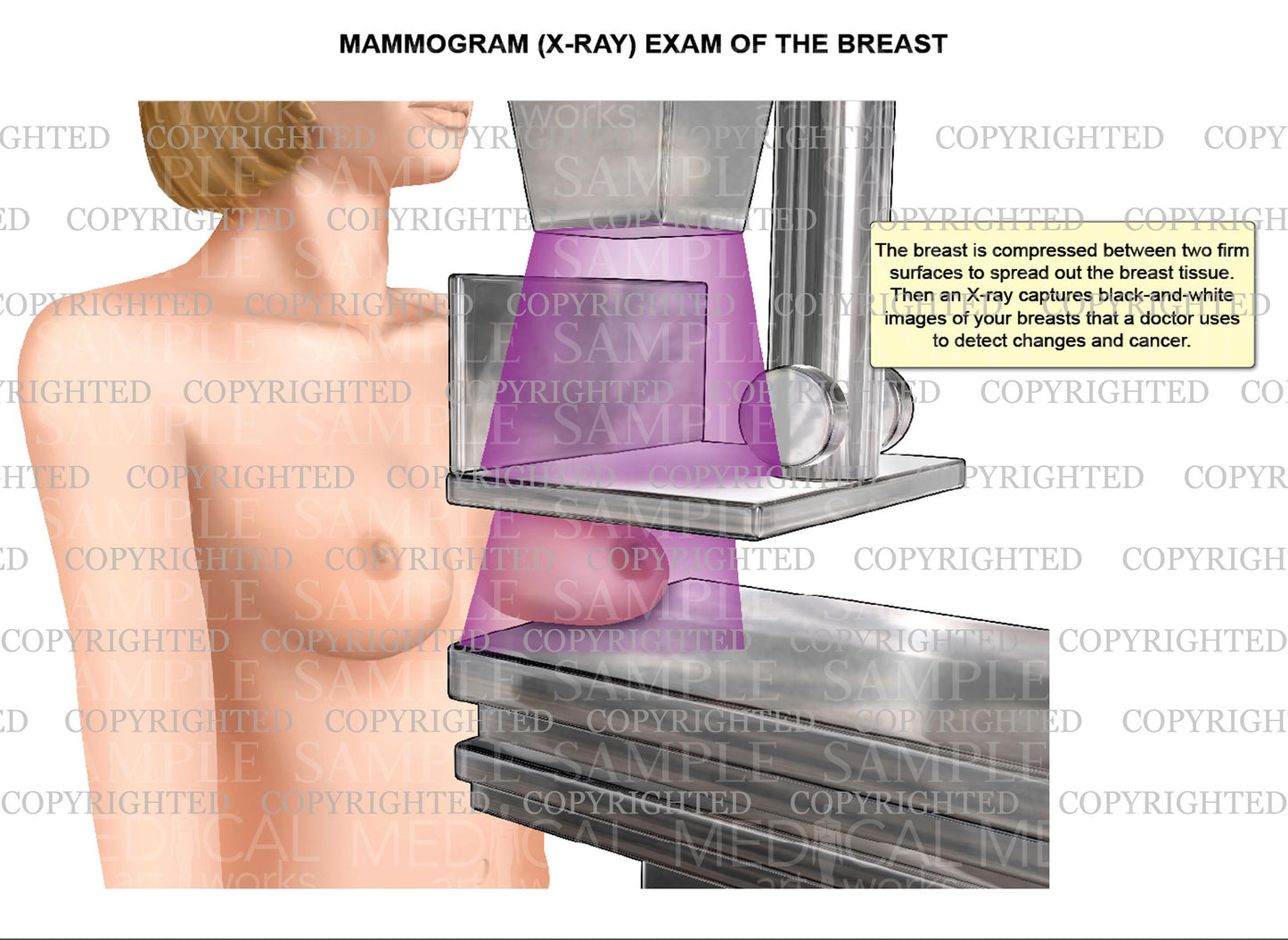 Mammogram (x-ray) exam of the breast