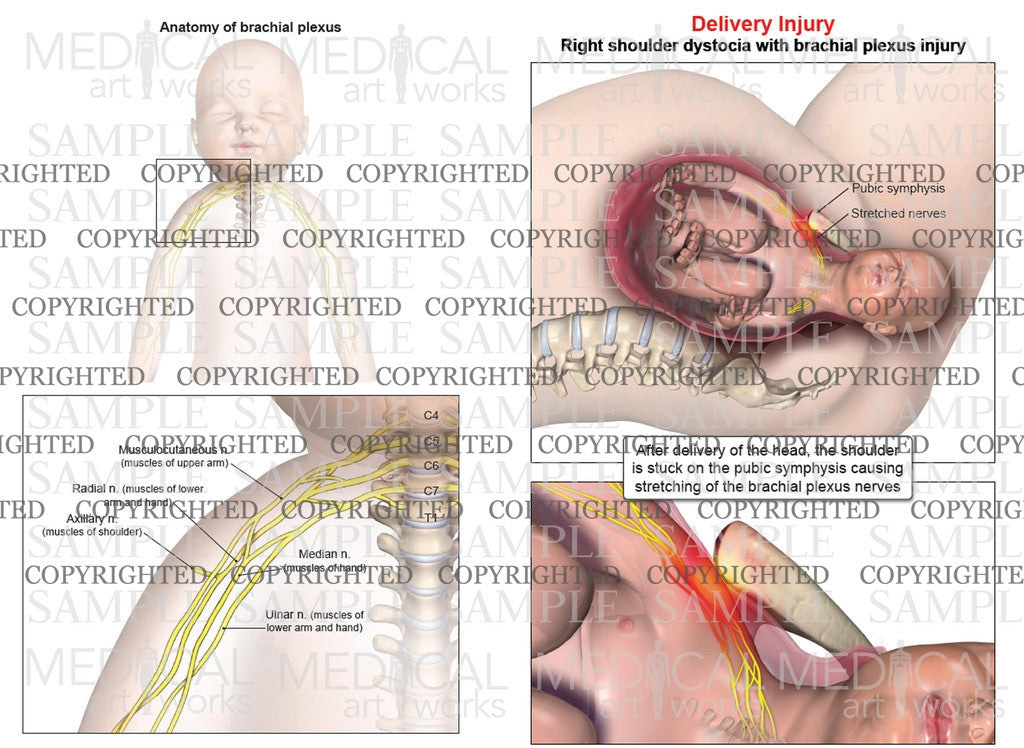 Right anterior shoulder dystocia