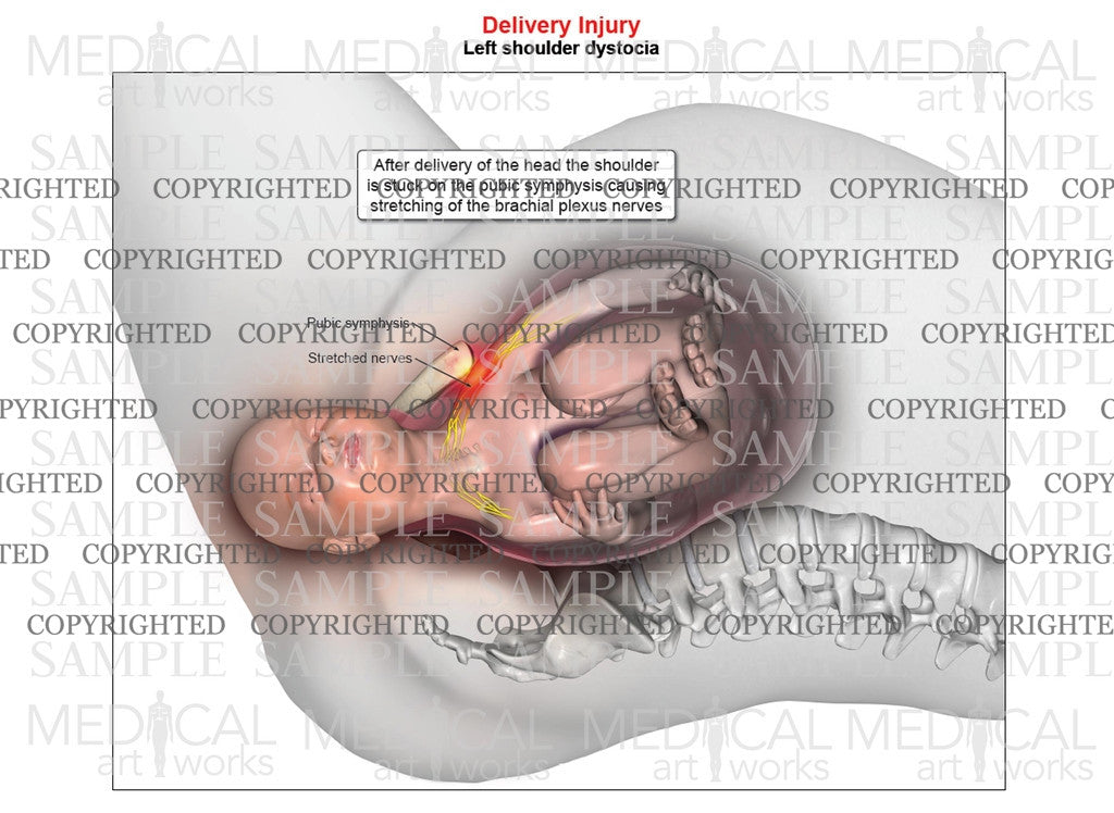 Left anterior shoulder dystocia (single image)