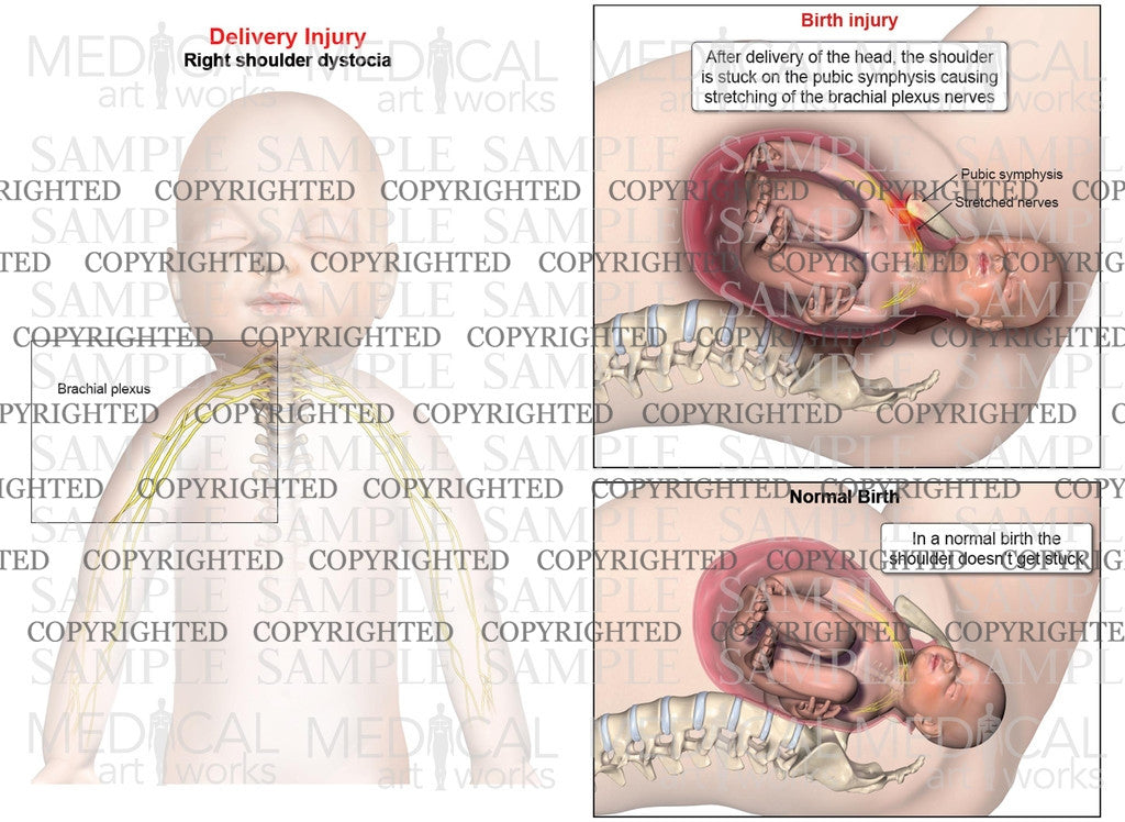 Right anterior shoulder dystocia and normal birth comparison