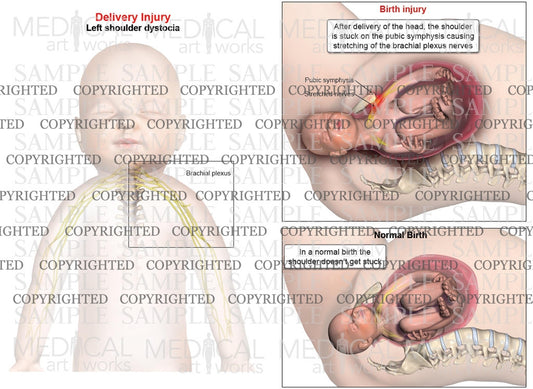 Left anterior shoulder dystocia and normal birth comparison