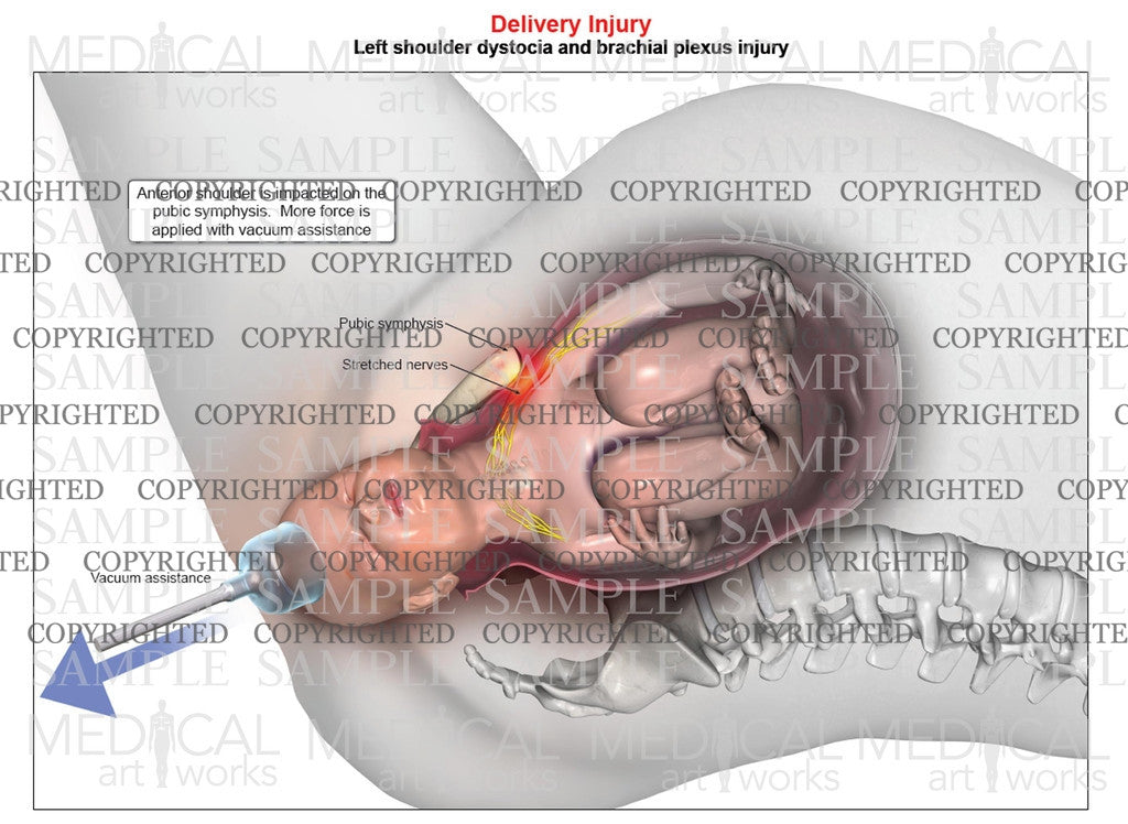 Left anterior shoulder dystocia with vacuum assistance. Single image