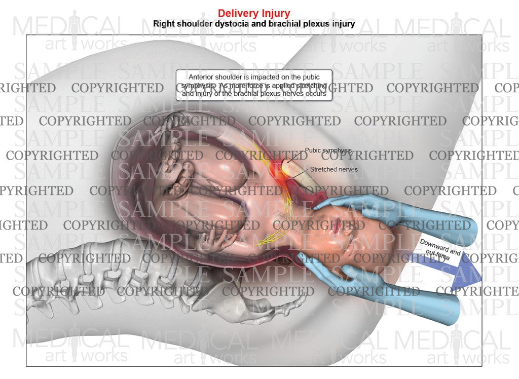 Right anterior shoulder dystocia with downward force assistance