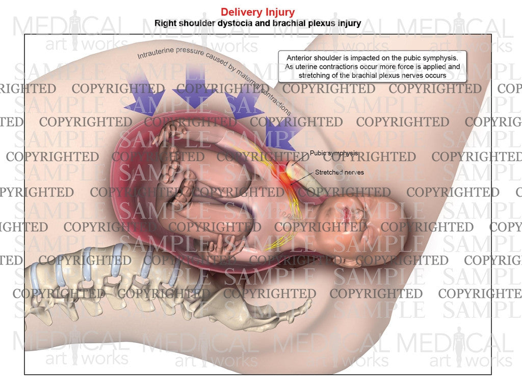Right anterior shoulder dystocia with maternal contractions