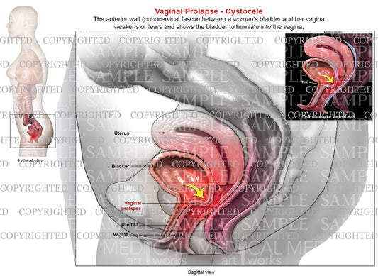 Vaginal Prolapse - Cystocele (fallen bladder)