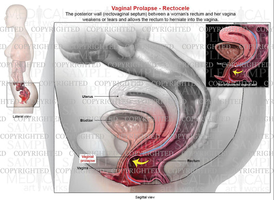 Vaginal Prolapse - Rectocele