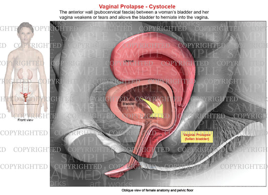 Vaginal Prolapse - Cystocele