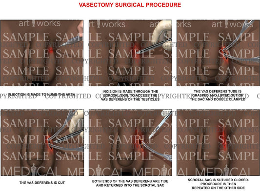 Vasectomy surgical procedure