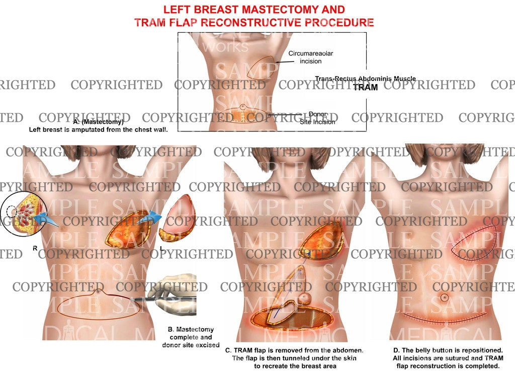 left breast mastectomy and Tram Flap reconstructive procedure