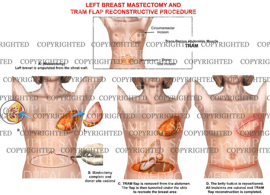 left breast mastectomy and Tram Flap reconstructive procedure
