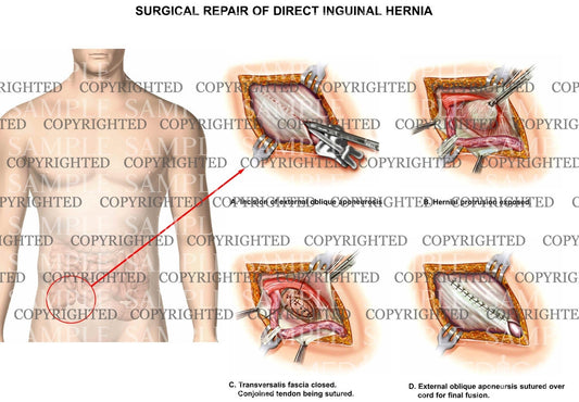 Inguinal hernia surgical repair