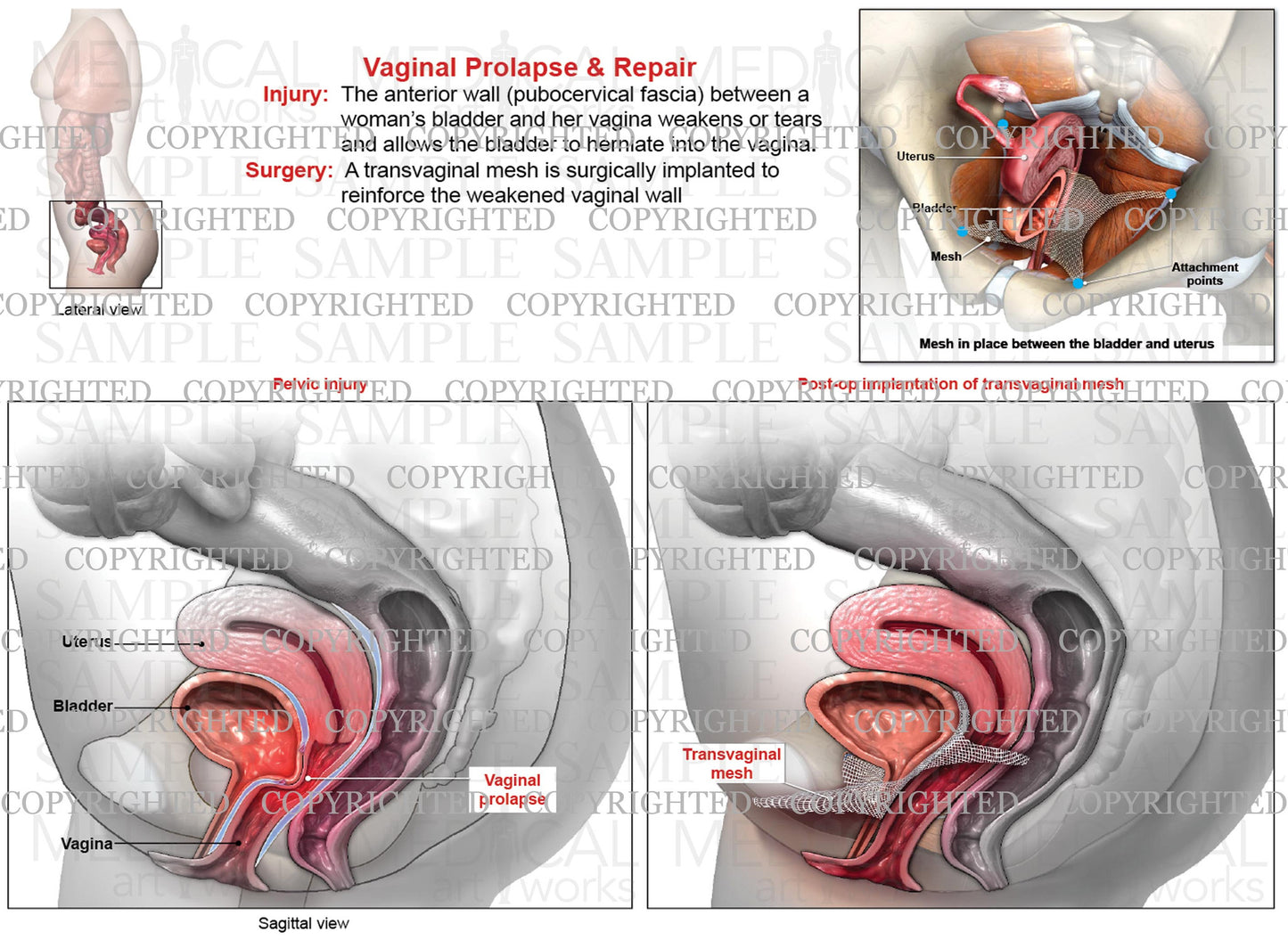 Vaginal Prolapse - Cystocele & Transvaginal Mesh Repair