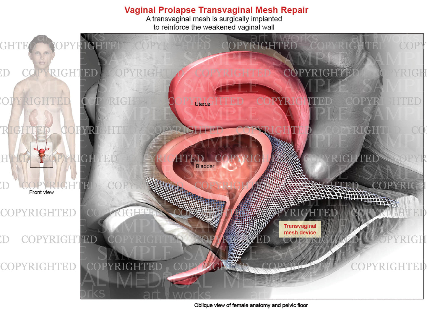 Transvaginal Mesh Repair of Vaginal Prolapse