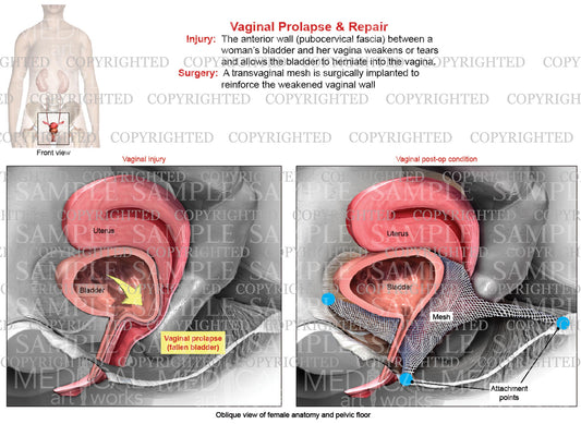 Vaginal Prolapse - Cystocele (fallen bladder) & Transvaginal Mesh Repair