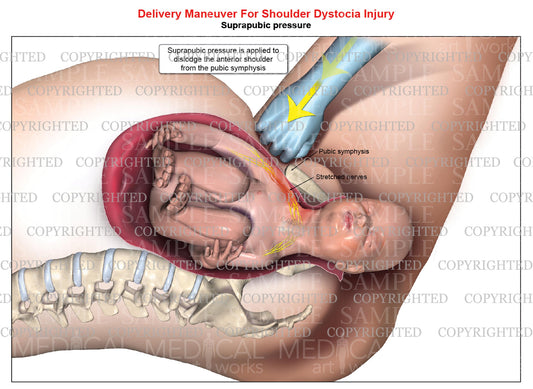 Suprapubic maneuver of right anterior shoulder dystocia - Delivery maneuver