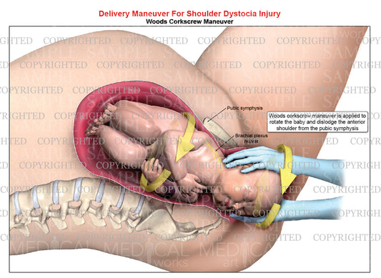 Woods Corkscrew maneuver of right anterior shoulder dystocia - Delivery maneuver