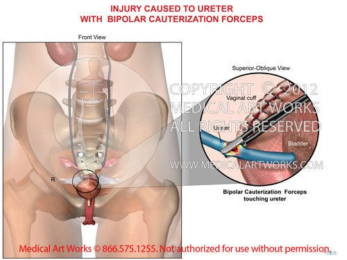 Ureteral injury caused with bipolar cauterization forceps