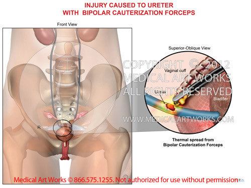 Ureteral injury caused with bipolar cauterization forceps - Thermal spread