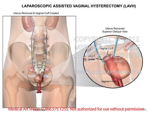 Laparoscopic assisted vaginal hysterectomy - LAVH