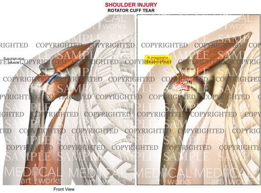 Shoulder injury