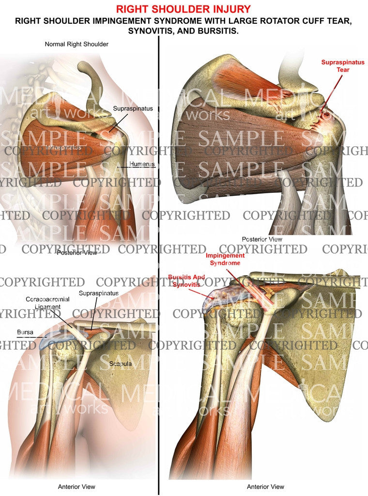 Right shoulder Impingement syndrome - large rotator cuff tear