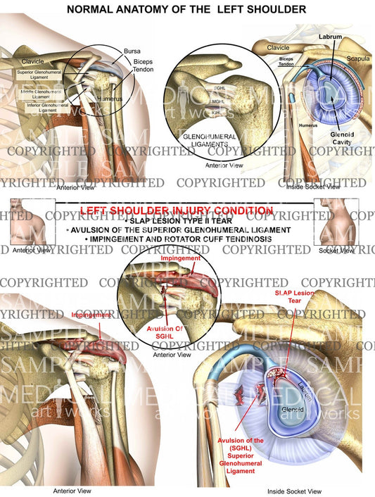 Left Shoulder Injury Condition 2