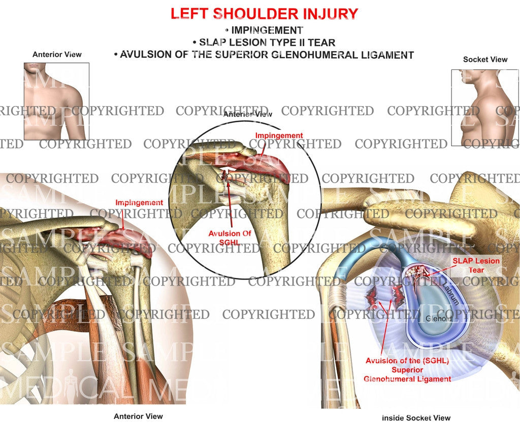 Left Shoulder injury / impingement