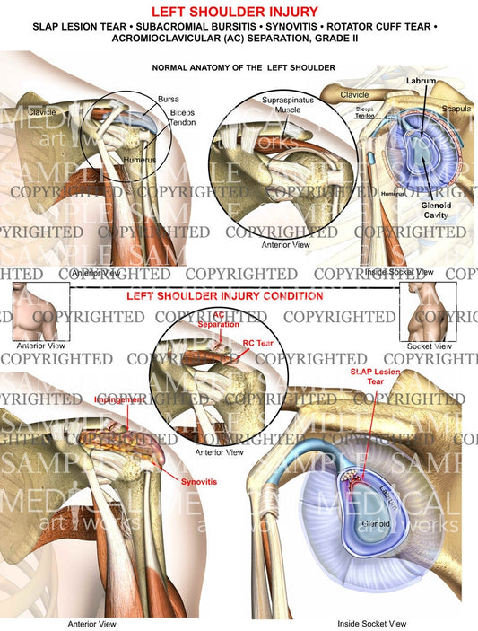 Left Shoulder Injury Condition