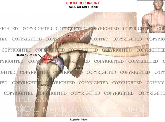 Shoulder tear