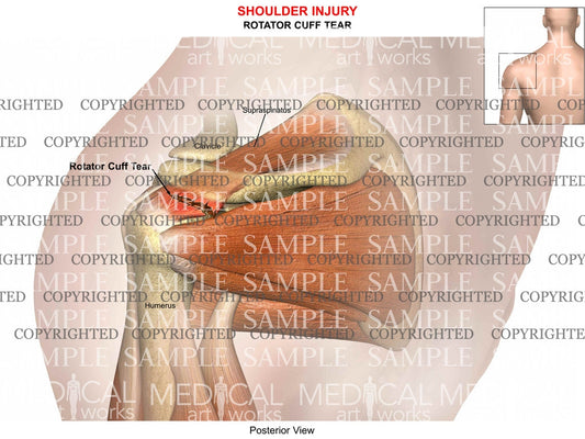 Rotator cuff tear