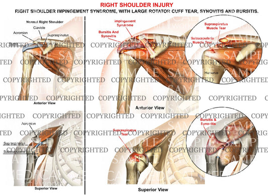Right shoulder impingement syndrome - rotator cuff tear