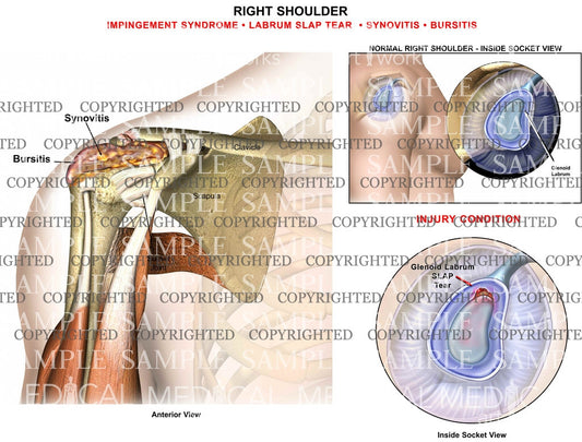 Right shoulder impingement syndrome
