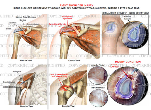Right shoulder impingement syndrome - RC tear - Slap tear - Intra-op photos