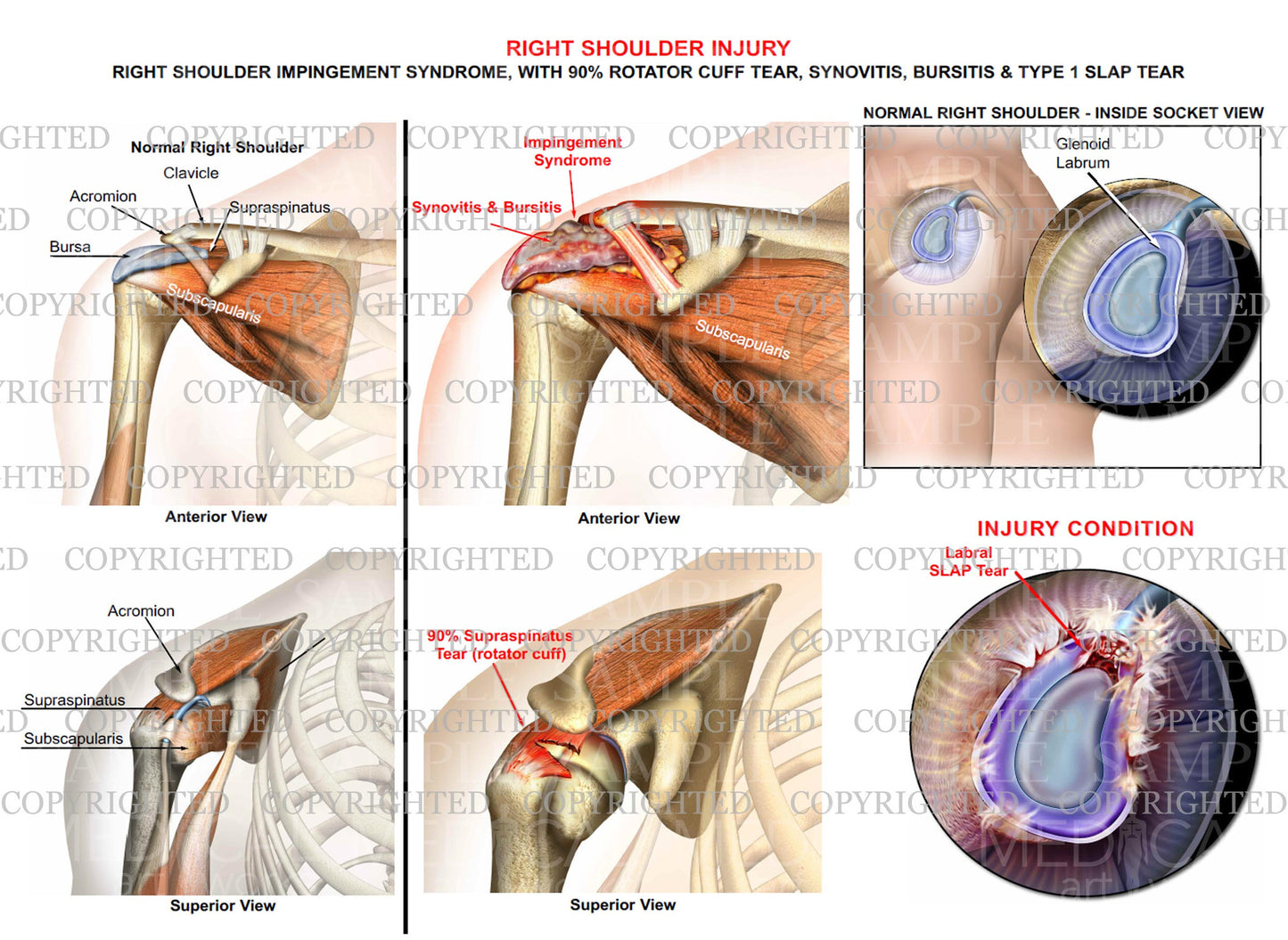 Right shoulder impingement syndrome - RC tear - Slap tear