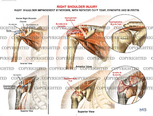 Right Shoulder injury 1