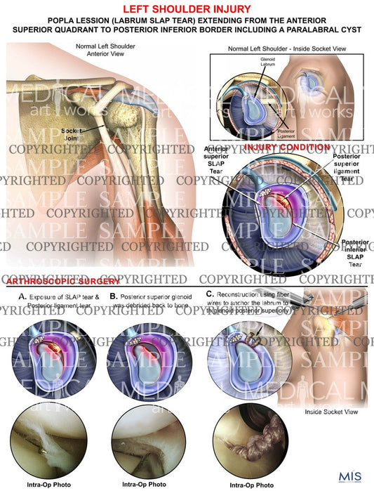 Left Shoulder injury & surgery